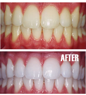 Professional Teeth Whitening And Bleaching In Colorado Springs Northgate Dental